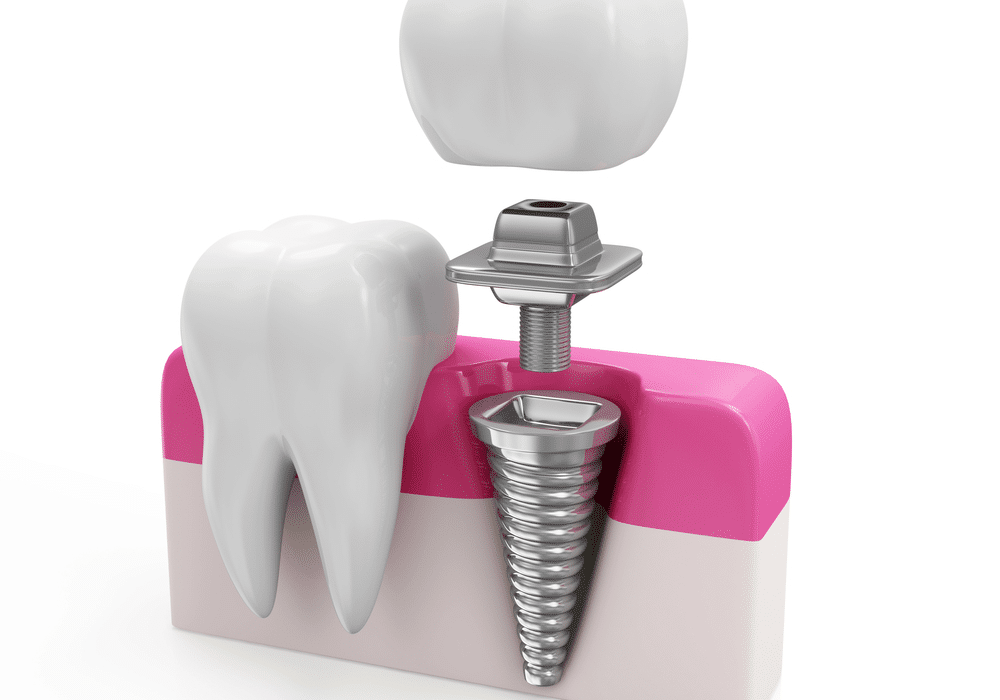 6_Things_to_Expect_When_Getting_Dental_Implants_638403873951666829