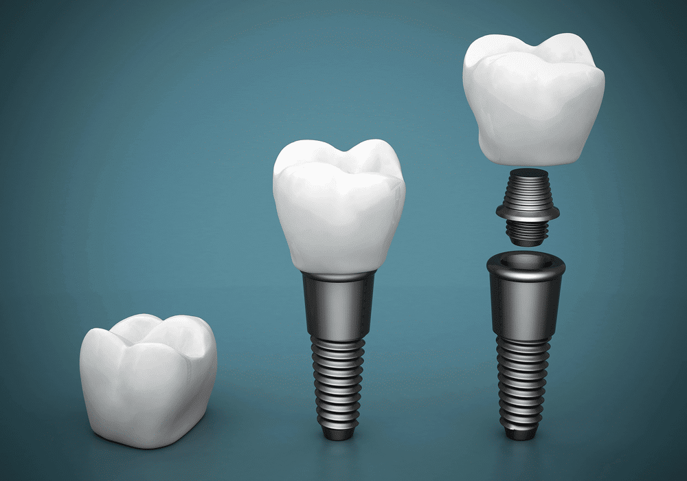 How_Do_Dental_Implants_Work_638418496435987392