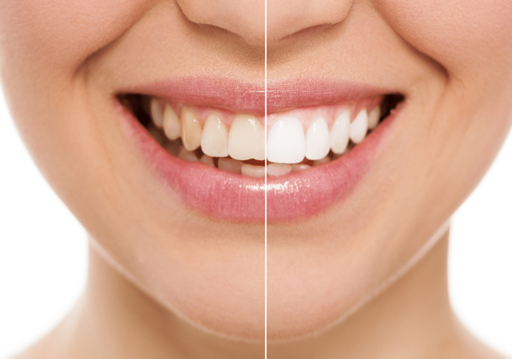 How_Long_Does_Professional_Teeth_Whitening_Take_638350357666013462